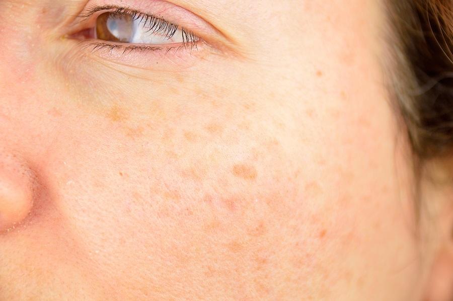 Age Spots Causes, Prevention + Ayurvedic Remedies For Age Spots