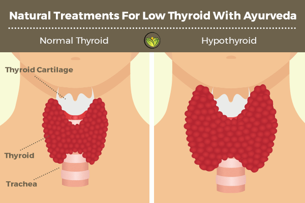 Ayurveda’s Natural Treatment For Low Thyroid (Underactive Thyroid)