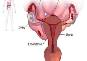 Endometriosis: An Ayurvedic perspective