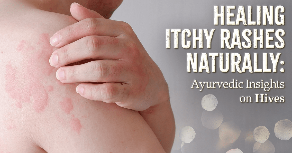 Healing Itchy Rashes Naturally: Ayurvedic Insights On Hives