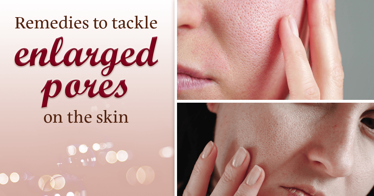 Here's How You Can Manage The Look Of Enlarged Pores: Ayurveda-Inspired & Natural Home Remedies