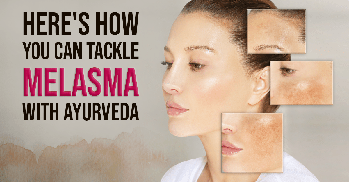 Melasma: Ayurvedic Tips To Tackle Hyperpigmentation And Glow Naturally!