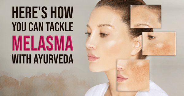 Melasma: Ayurvedic Tips To Tackle Hyperpigmentation And Glow Naturally