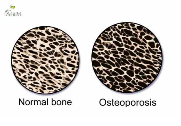 Osteoporosis Treatment, Prevention + Ayurvedic Remedies, Therapies