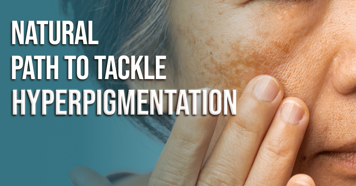 The Natural Path To Tackle Hyperpigmentation: Causes And Remedies